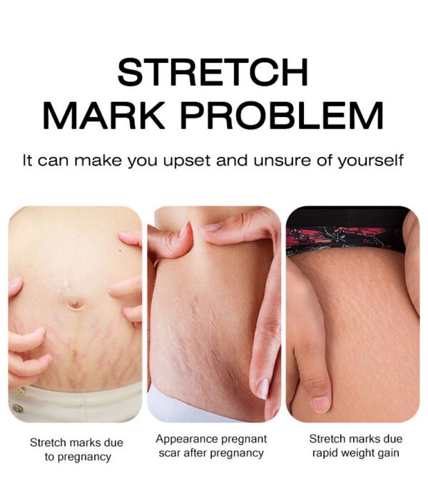 MOIKA Strong Effective Acne Scar Removal Cream Pimples Stretch Marks Face Gel Tummy Tuck Tightening Stretch Mark Removal Cream - Image 2